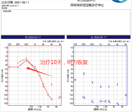 突聋女孩10天恢复听力，避免了植入人工耳蜗，这
