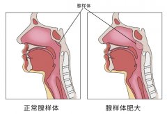 【辟谣】腺样体面容不只是腺样体肥大引起，还
