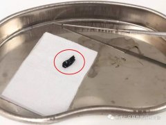 因弟弟一个动作，造成姐姐耳内鲜血长流……
