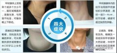 甲状腺结节“盯上”年轻人，你还能成为荣耀里