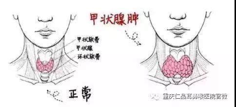 甲状腺肿大