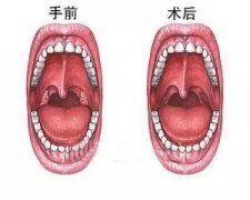 孩子扁桃体肥大，到底要不要手术？