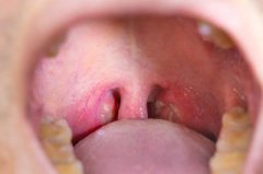 小孩打鼾必须手术吗？能不能保守治疗？