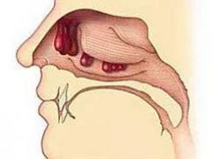 预防鼻息肉的方法