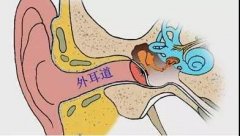 外耳道炎常见的护理措施