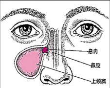 鼻息肉的症状及治疗方法