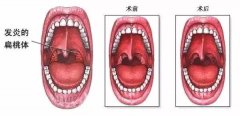 重庆医保定点医院_儿童扁桃体炎的危害