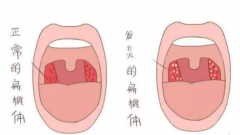 扁桃体炎复发的原因是什么？重庆扁桃体炎 哪家