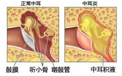 中耳炎的症状有哪些-重庆耳鼻喉医院排名