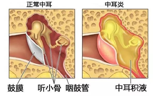 中耳炎的症状有哪些