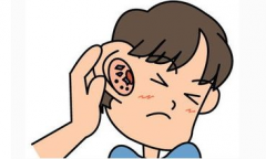 打耳光也可能造成鼓膜穿孔？