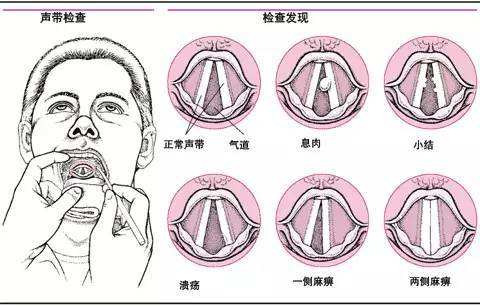 重庆专业耳鼻喉科医院推荐_声带小结有哪些危害