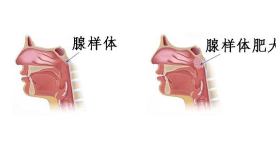 重庆仁品耳鼻喉专科医院_哪些原因会导致腺样体