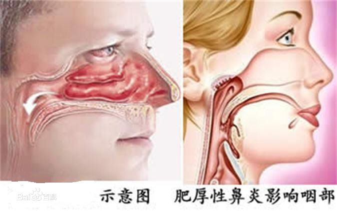 重庆耳鼻喉医院排名_肥厚性鼻炎的治疗方法