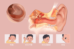 分泌性中耳炎,分泌性中耳炎的三种病因