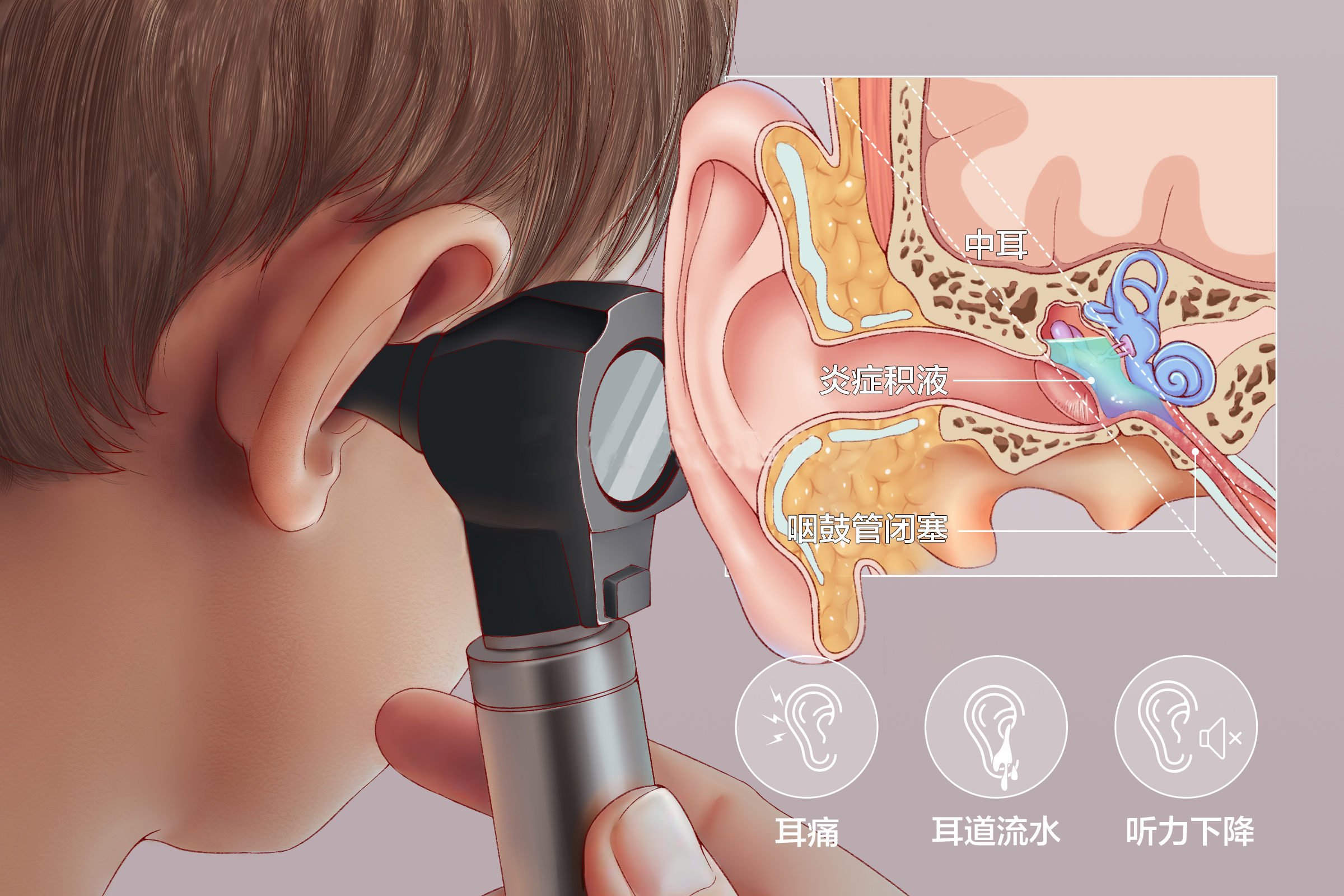 中耳炎的治疗方法