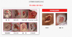 先天性耳廓形态畸形的治疗方法