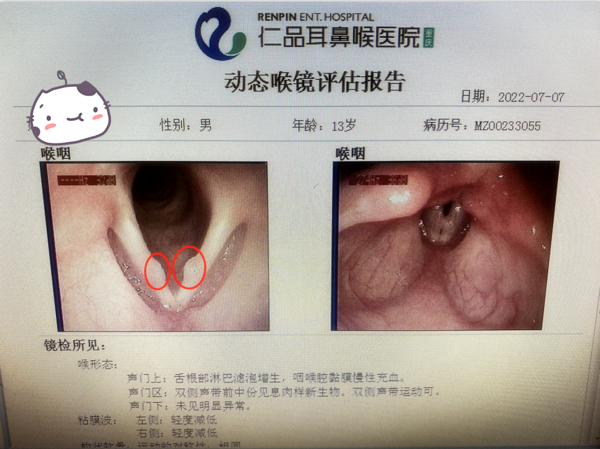 双侧声带息肉