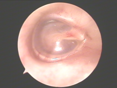 耳鼻喉急症之突发性耳聋
