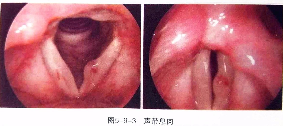 重庆看声带息肉医院