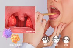 重庆医保定点耳鼻喉医院，急性扁桃体炎的症状
