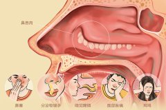 鼻息肉的最佳治疗方法,重庆医保定点耳鼻喉医院