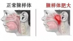为什么现在腺样体肥大的孩子越来越多？耳鼻喉