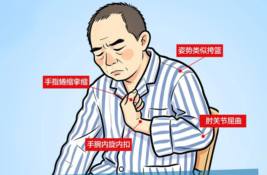 摆脱偏瘫挎篮手，仁品康复教你正确训练法
